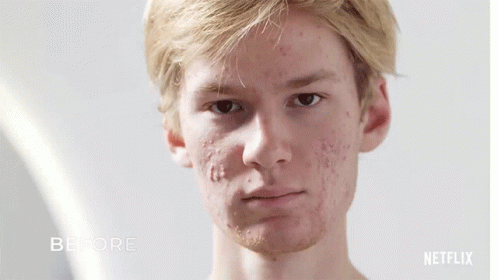 Acne